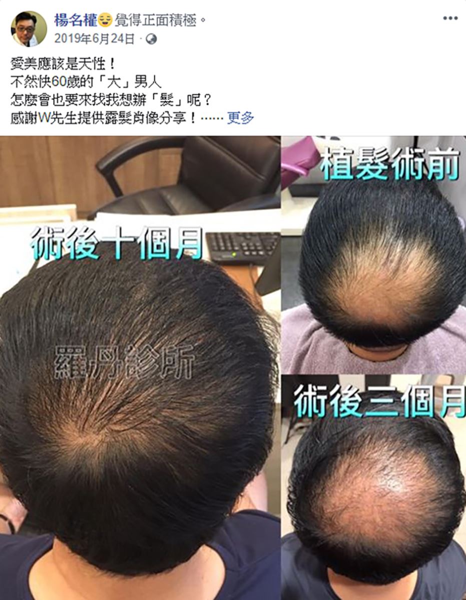 植髮,生髮613,禿頭 掉髮 